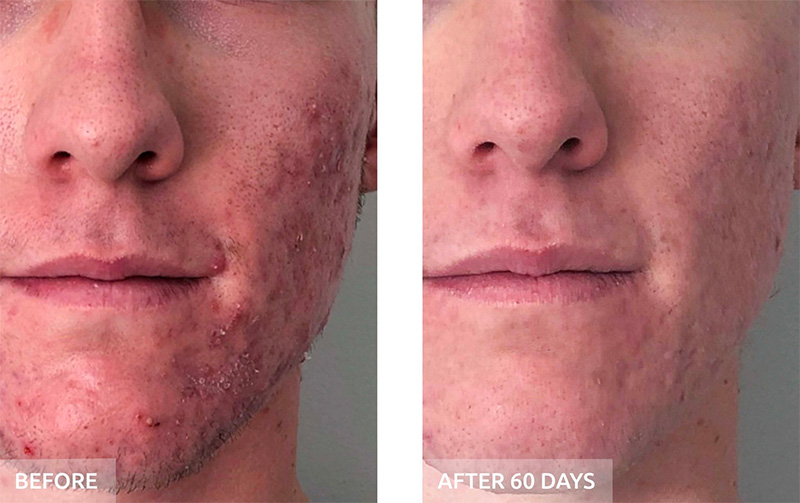 acne before and after